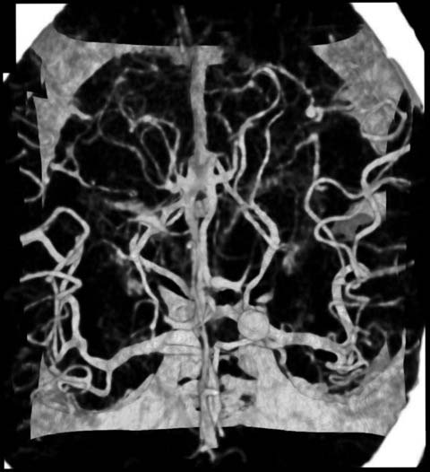 A 3D medical dataset of a brain aneurysm without bifocal distortion (Cohen et al. 2005)